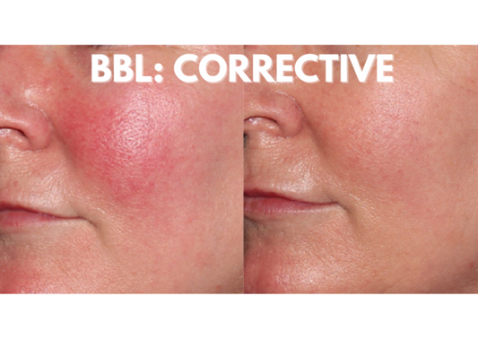 BBL: Corrective (3 Treatment Package)